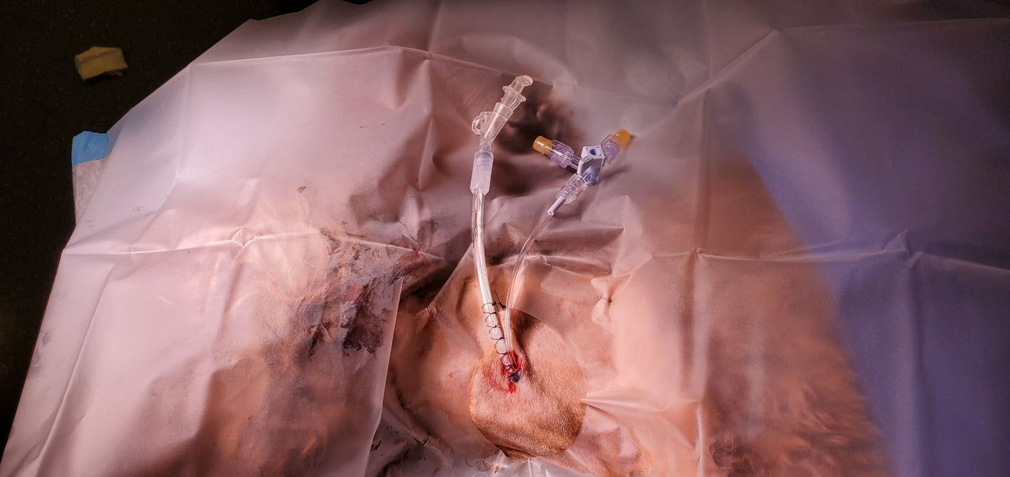 Esophageal Feeding Tube with Balloon Dilator