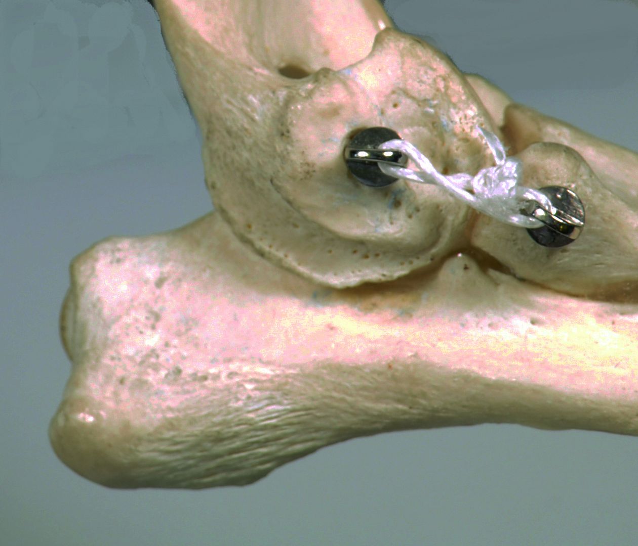 Ligafiba® Jänne- ja nivelsideompeleet | eri kokoja