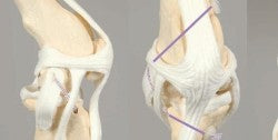 Ligafiba Iso Toggle Sutures | eri kokoja