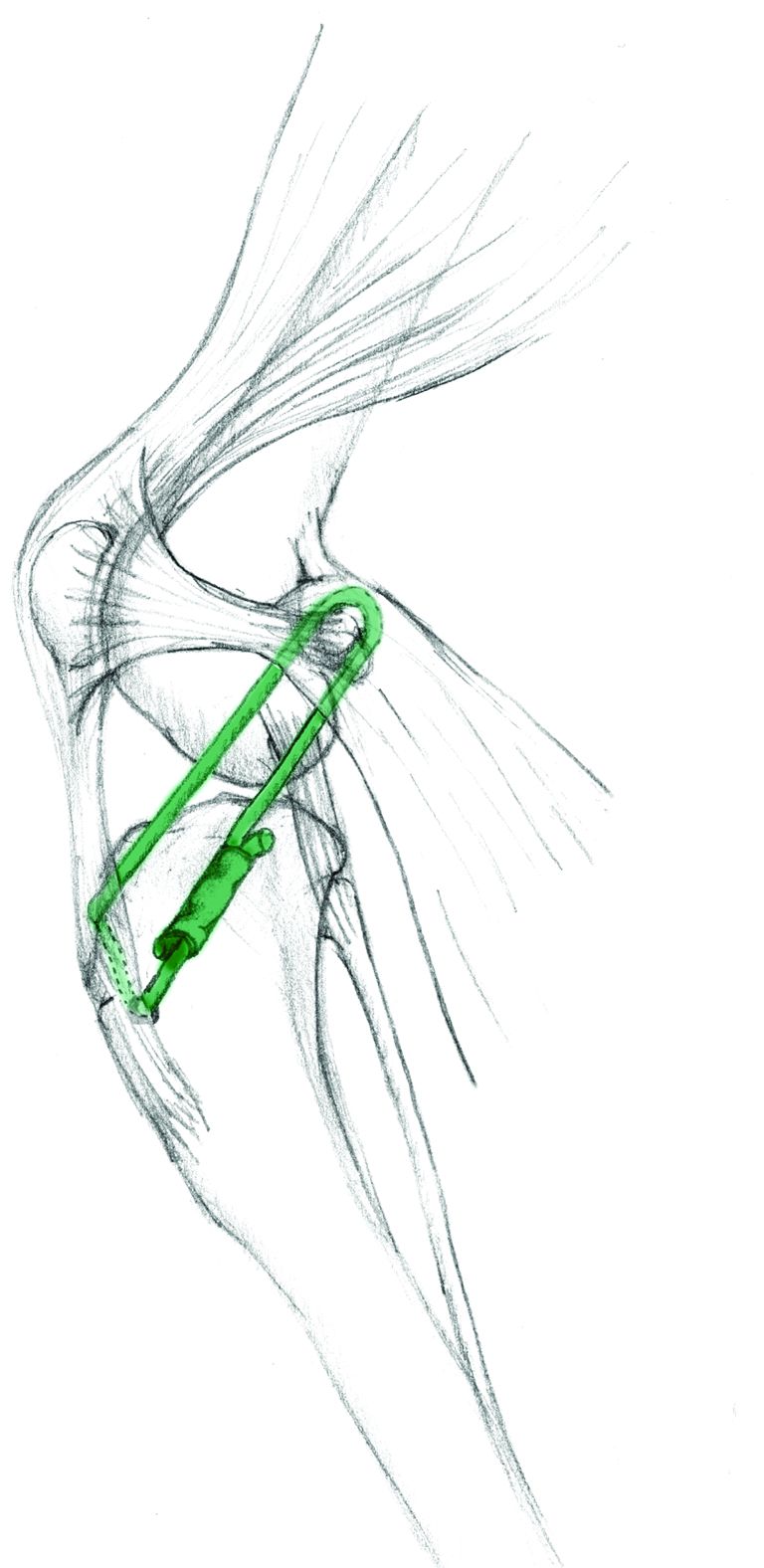 Steriili Nylon Double Leader Line + Neula + Puristusholkki